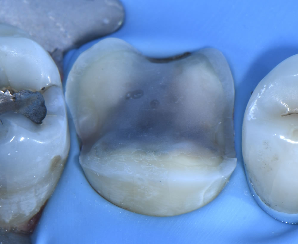 Graeme Milicich: 6 Fracture Modes of Teeth & The Compression Dome Concept
